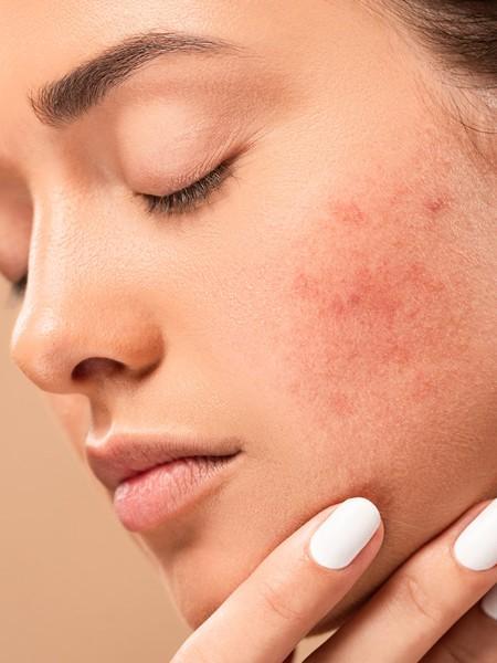Traitement des cicatrices du visage – Medesthétique