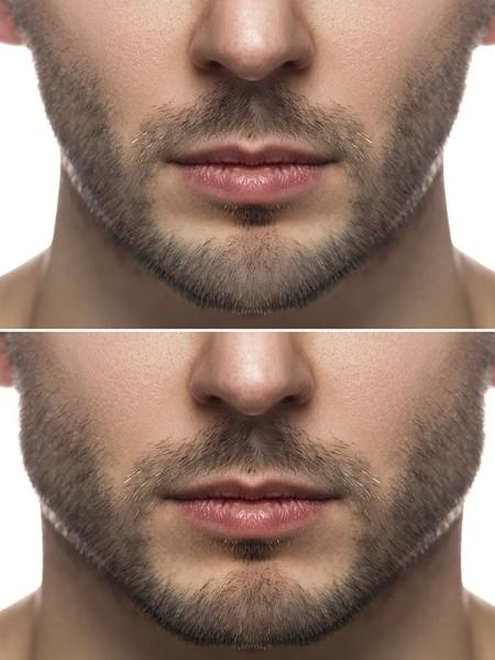 Jawline contouring – Medesthétique