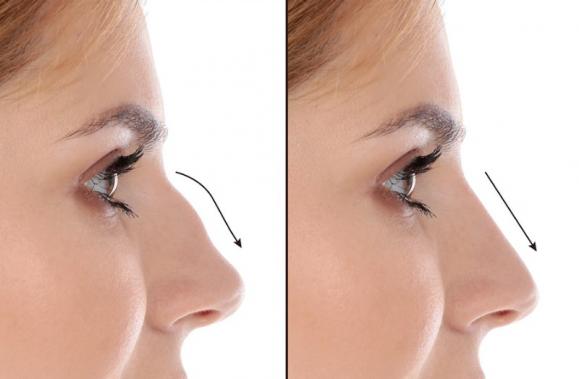 Rhinoplastie médicale – Medesthétique