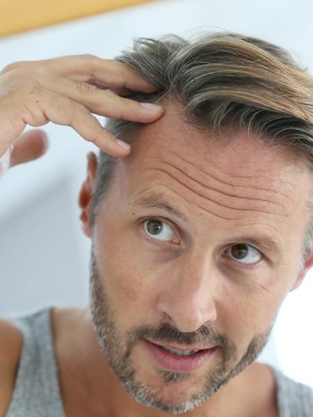Greffe de cheveux – Medesthétique