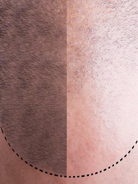 Greffe de cheveux – Medesthétique