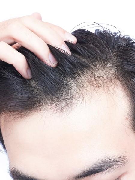 Pigmentation du cuir chevelu – Medesthétique