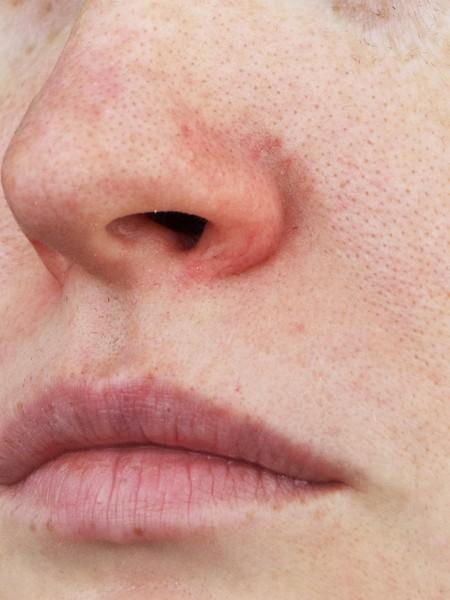 Traitement de la couperose au laser – Medesthétique