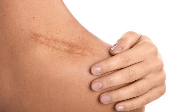 Pigmentation des cicatrices – Medesthétique