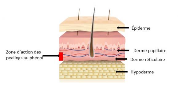 Peeling profond au phénol – Medesthétique