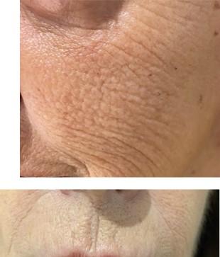 Peeling profond au phénol – Medesthétique