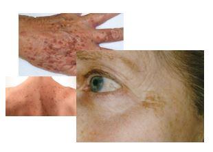 Taches pigmentaires traitées au laser PicoSure – Medesthétique