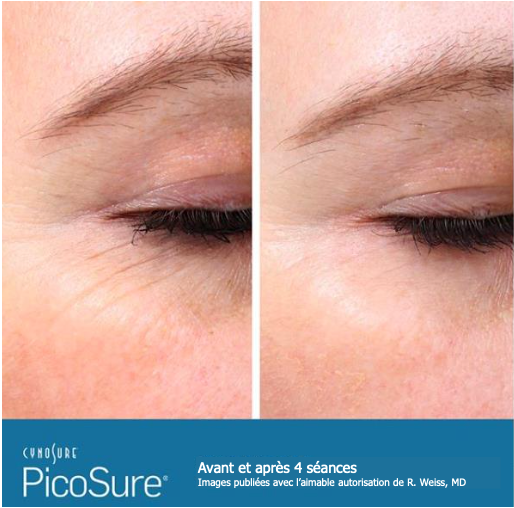 Rajeunissement cutané au laser PicoSure – Medesthétique