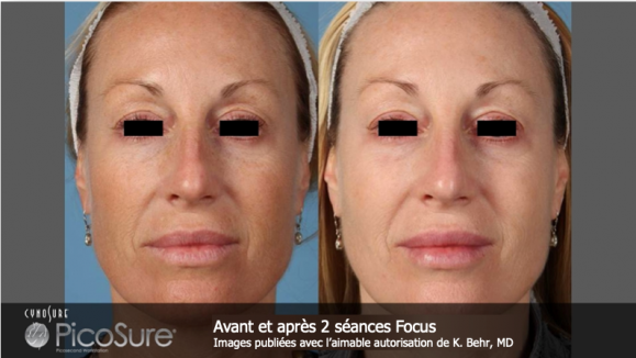 Rajeunissement cutané au laser PicoSure – Medesthétique
