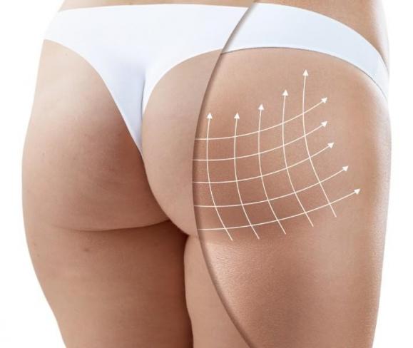 Galbe des fesses par injection d'acide hyaluronique – Medesthétique