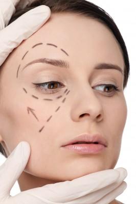Lifting médical par Radiesse – Medesthétique