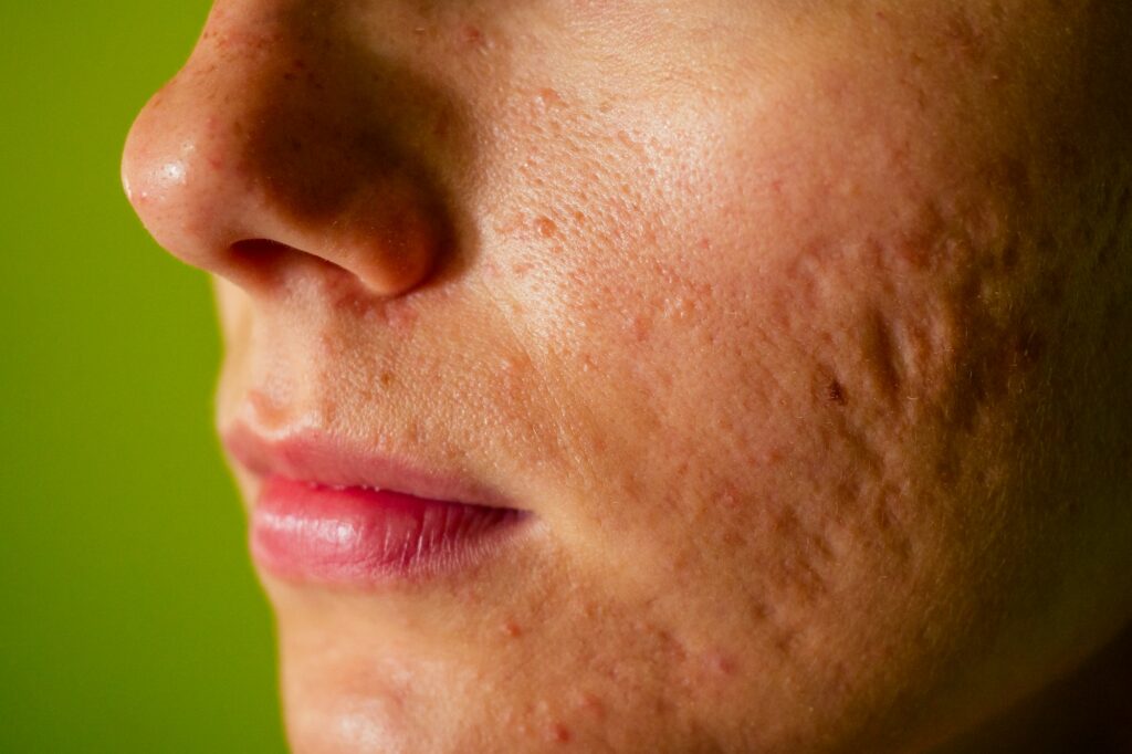 Cicatrices d'acné sur un visage – Medesthétique