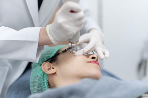 Traitement des cernes pigmentaires au laser – Medesthétique