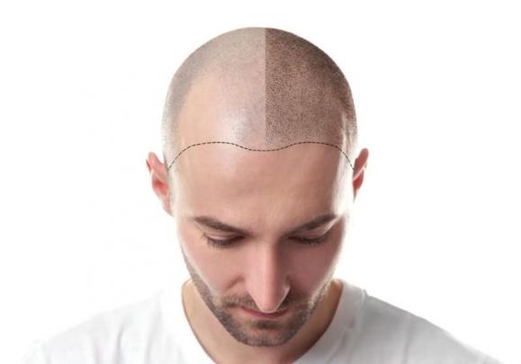 Tricopigmentation du cuir chevelu chez l'homme – Medesthétique
